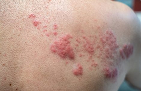 Shingles (Disease), Herpes zoster, varicella-zoster virus. skin rash and blisters on the back.