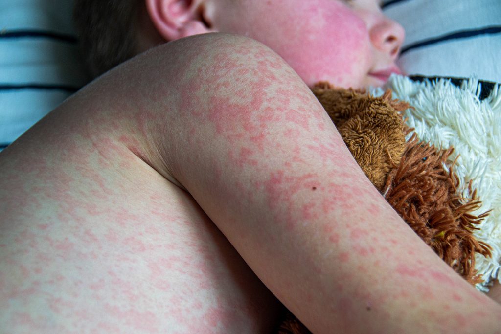 Measles outbreaks in Texas and New Mexico