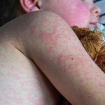 Measles outbreaks in Texas and New Mexico